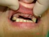 Потеря зубов в сочетании с деформацией зубных рядов